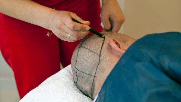 חדשנות בטיפול בנשירת שיער: פתרונות מתקדמים לגברים